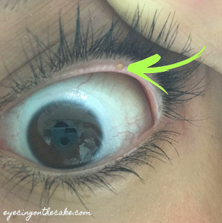 An eye with a green arrow pointing to a yellow dome on the eyelid margin, which is a capped meibomian gland