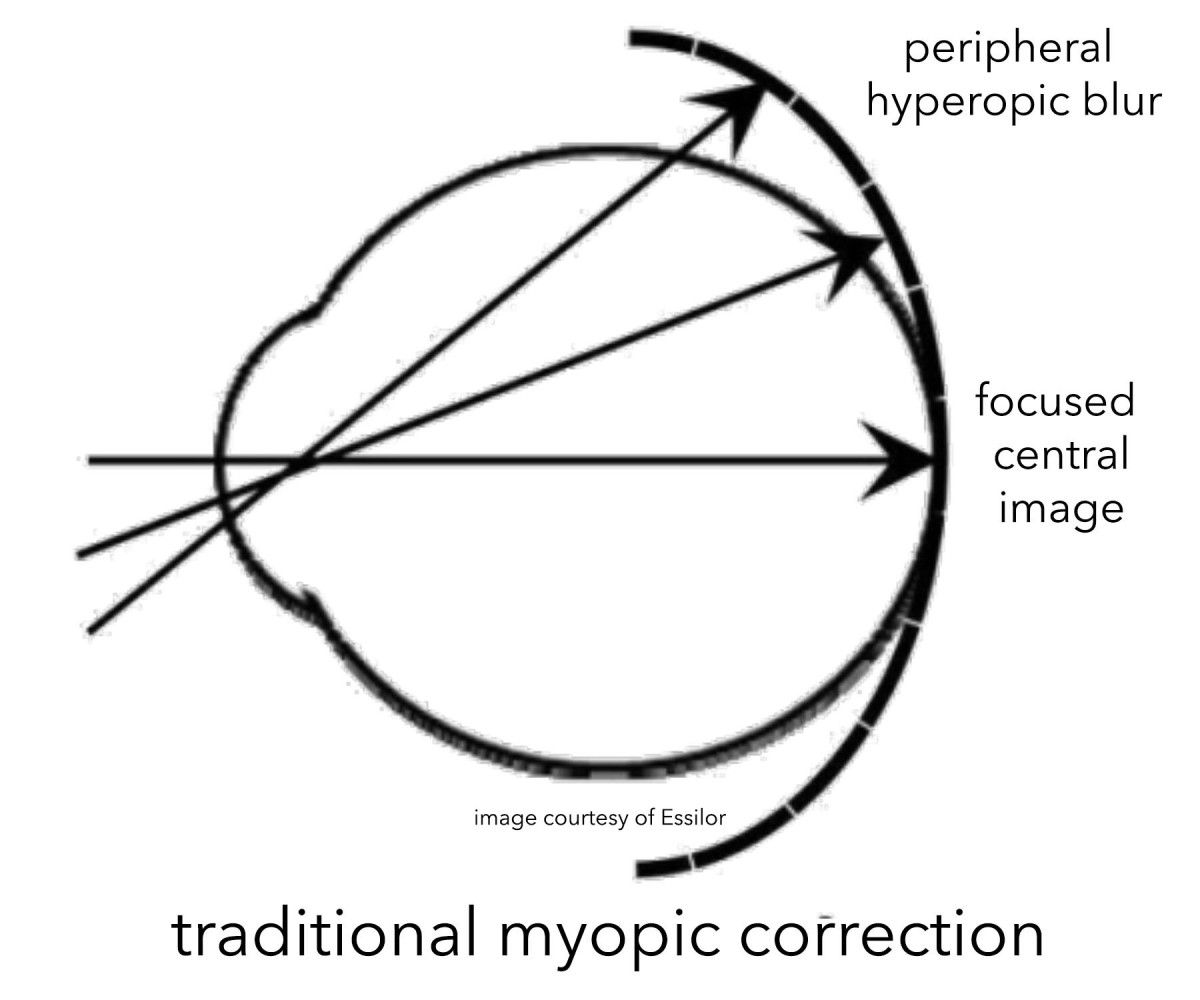A sketch showing how traditional myopic correction gives a focused central image, but leaves peripheral hyperopic defocus.