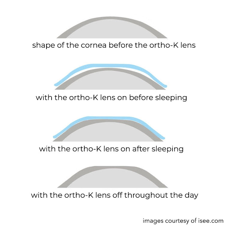 A series of diagrams of the cornea: first shows the shape of the cornea before the ortho-K lens, second shows the shape of the cornea with the ortho-K lens on before sleeping, third shows the shape of the cornea with the ortho-K lens on after sleeping, and fourth shows the shape of cornea with the ortho-K lens off during the day.